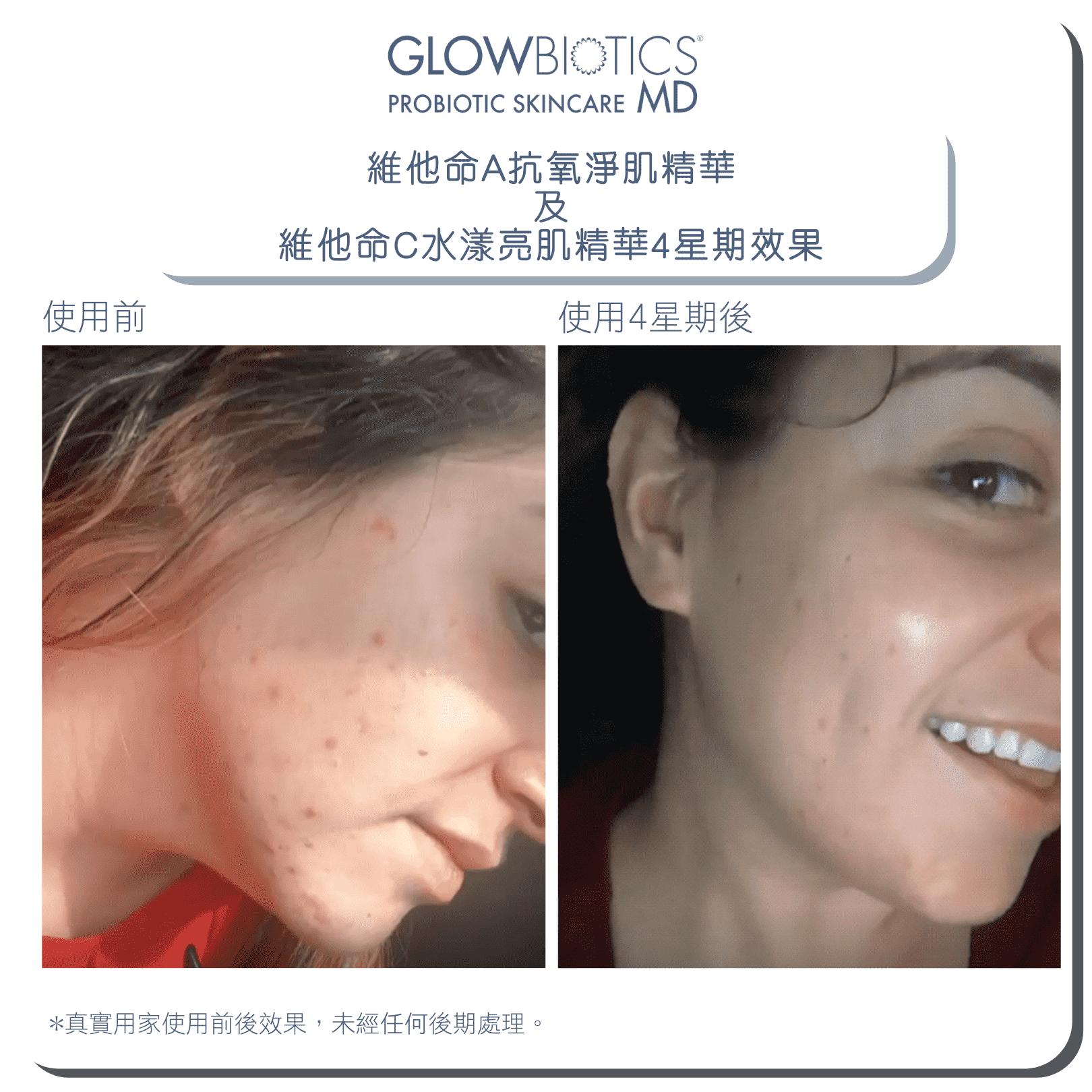 GLOWBIOTICS® 16+ 抗氧淨肌套裝 (年輕肌) - Derm-Mart