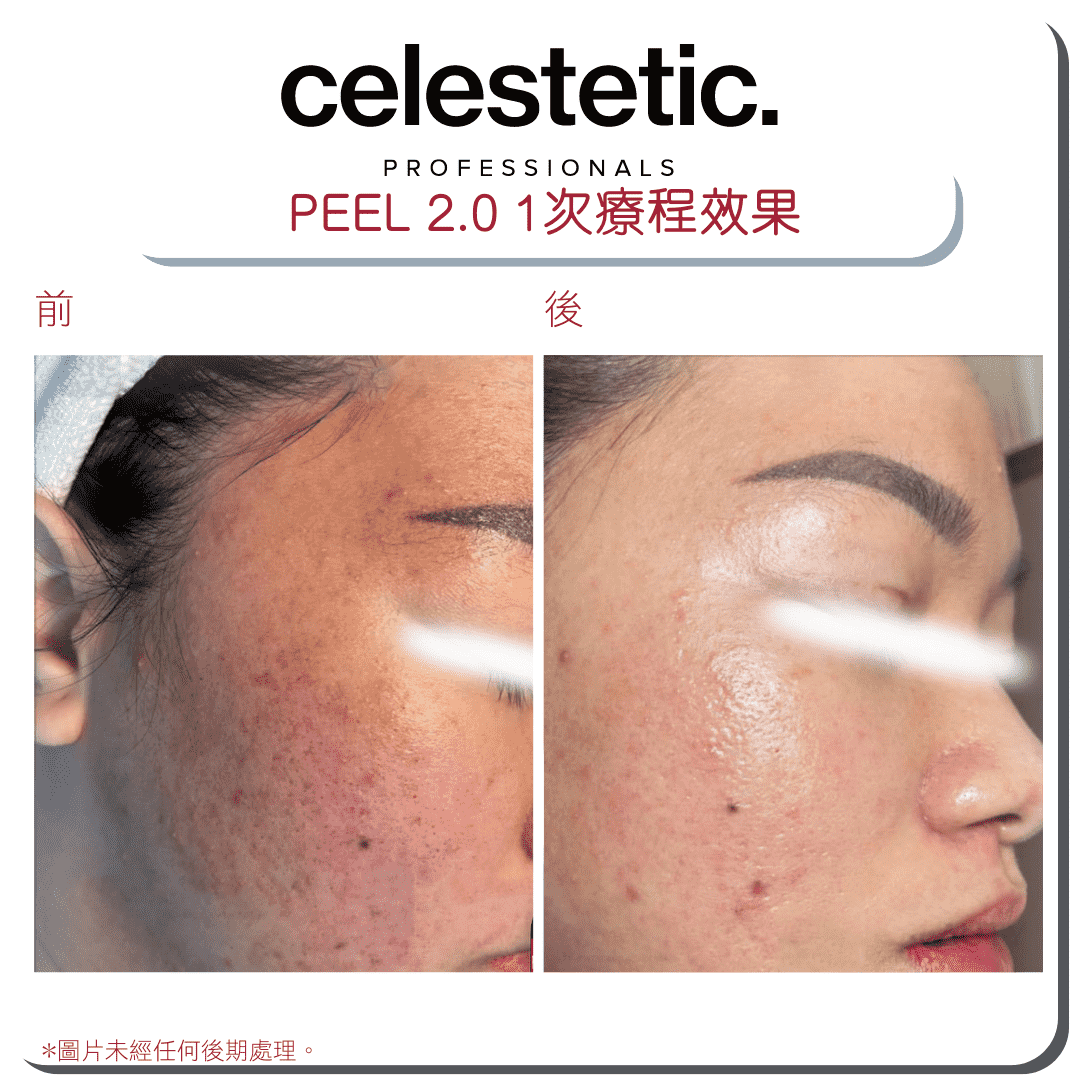 Celestetic. Peel 2.0 針對性換膚療程 - Derm-Mart
