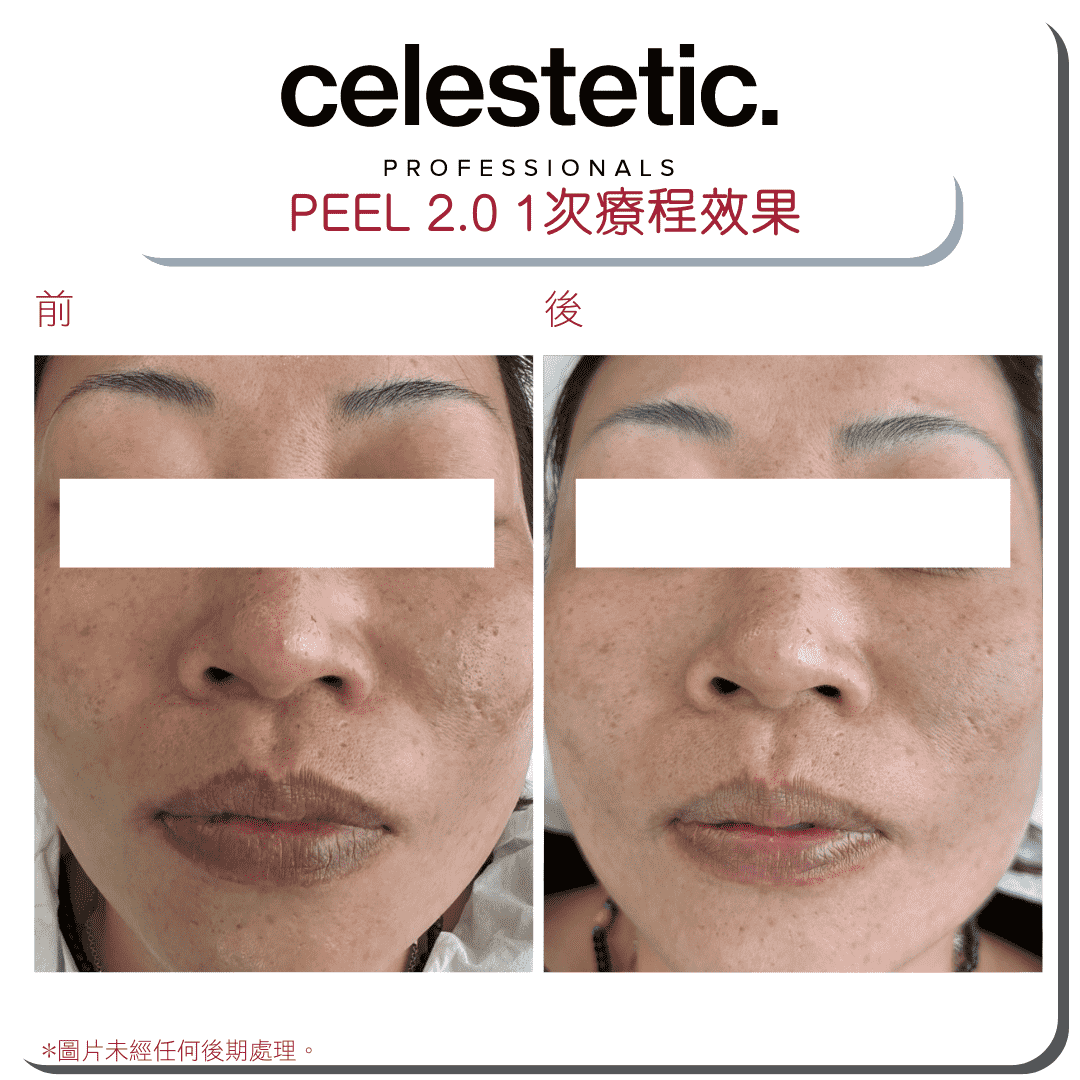 Celestetic. Peel 2.0 針對性換膚療程 - Derm-Mart