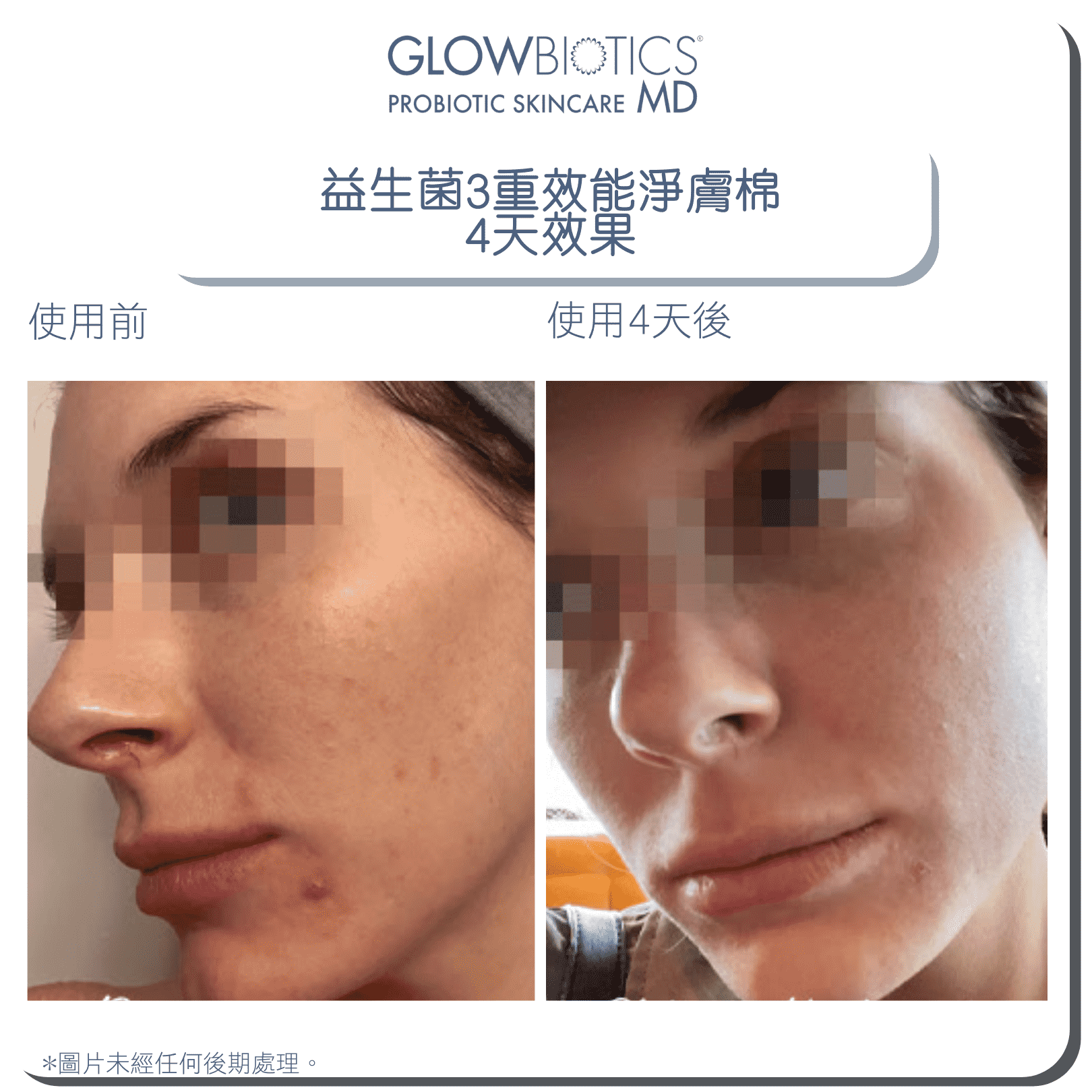 GLOWBIOTICS® 25+ 激活煥肌套裝 (輕熟肌) - Derm-Mart