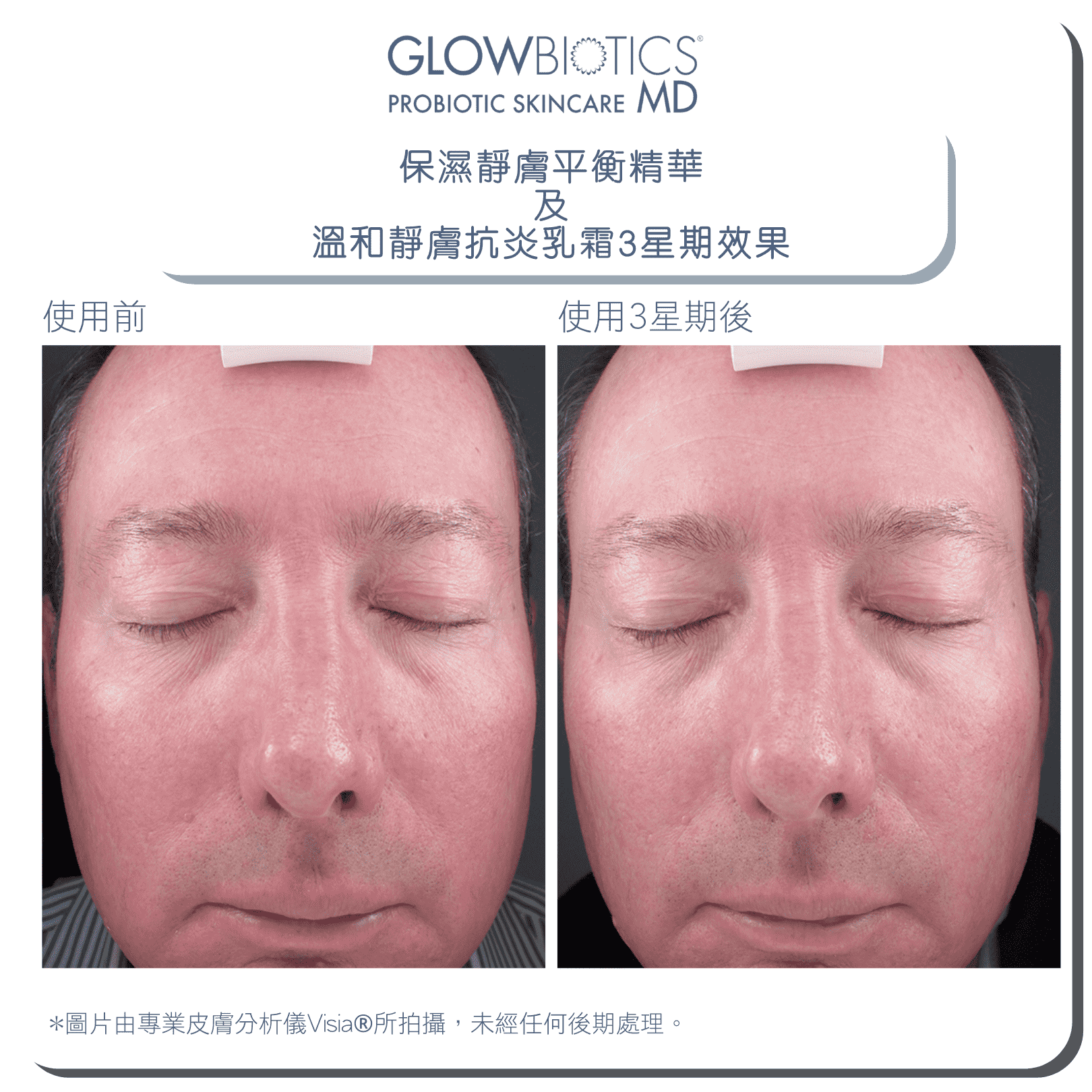 GLOWBIOTICS x 田豪祖3寶優惠益生菌抗敏保濕套裝 - Glowbiotics HK