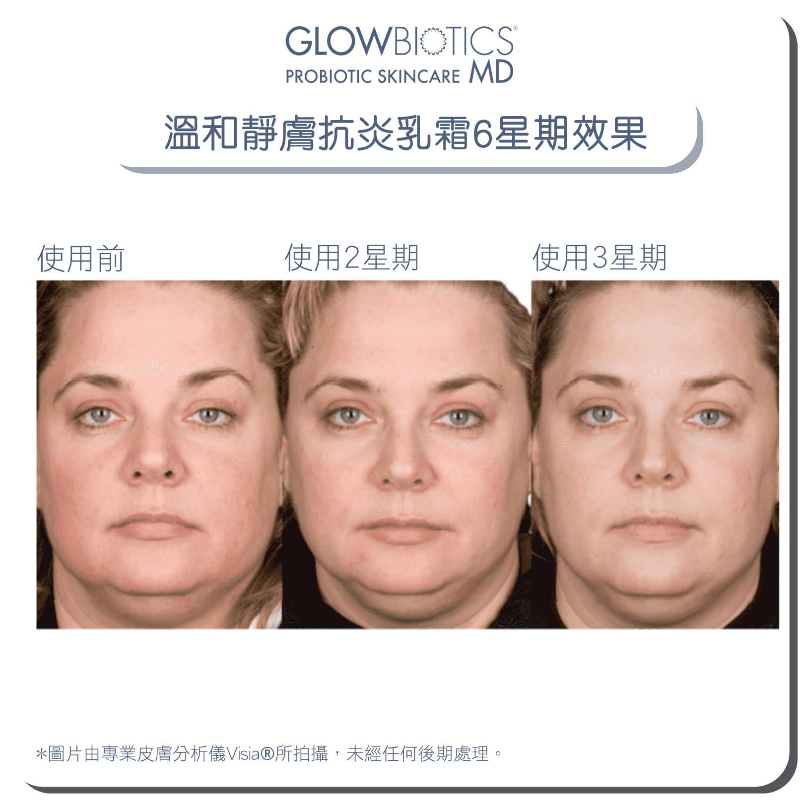 GLOWBIOTICS x 田豪祖3寶優惠益生菌抗敏保濕套裝 - Glowbiotics HK